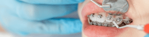 Nahaufnahme: Untersuchung eines Mundes mit Zahnspange.